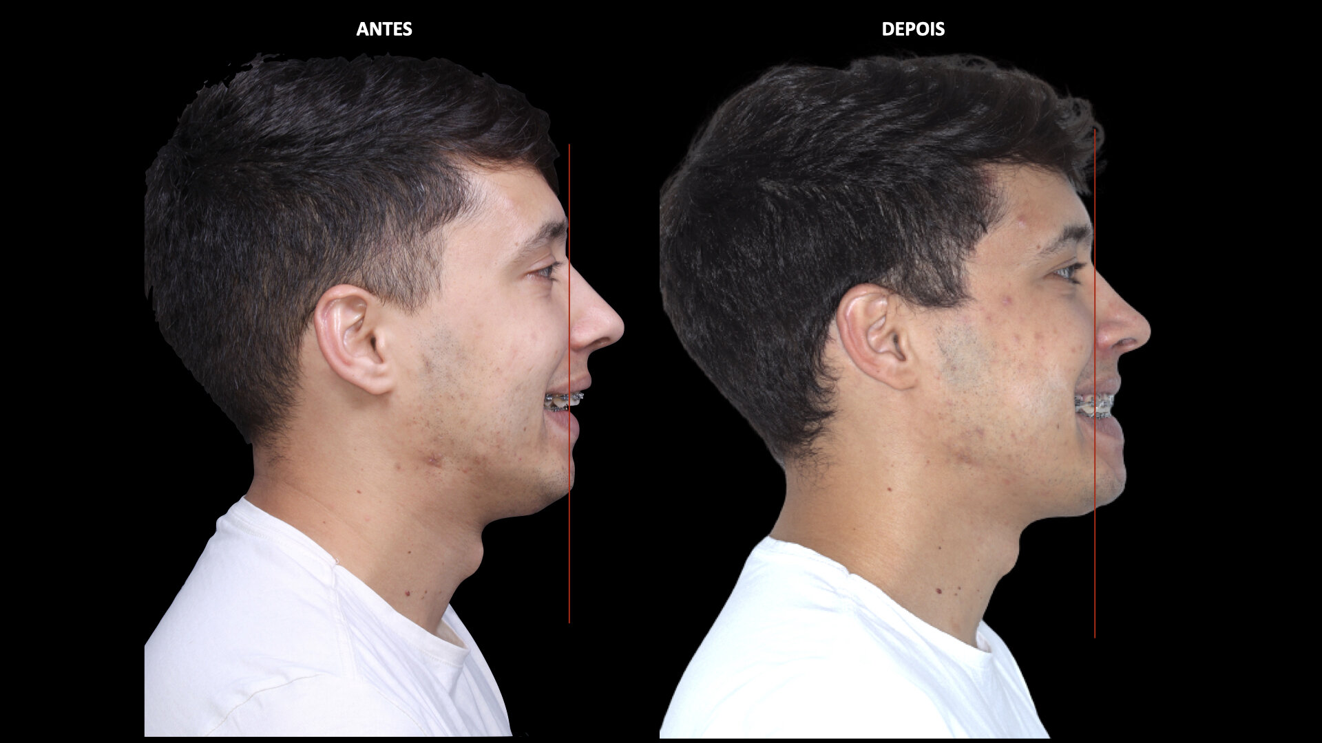 Cirurgia Ortogn tica Dr Pablo Leite Cirurgi o Bucomaxilofacial